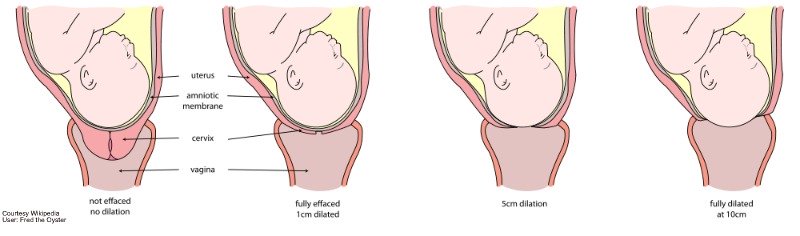 guide to cervix dilation labor dilation and effacement chart